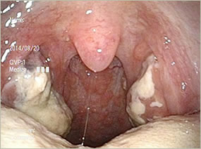 白い 扁桃 腺 喉の奥に白いできものが！３つの原因と対処法をご紹介！